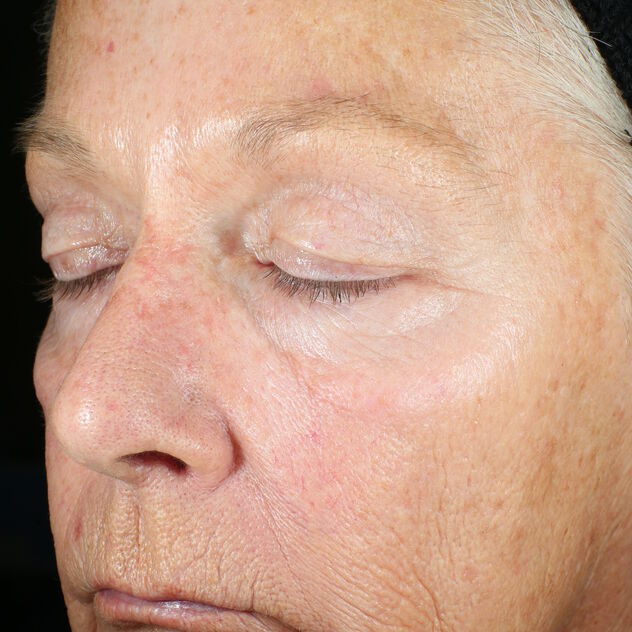 Zoskin - After
